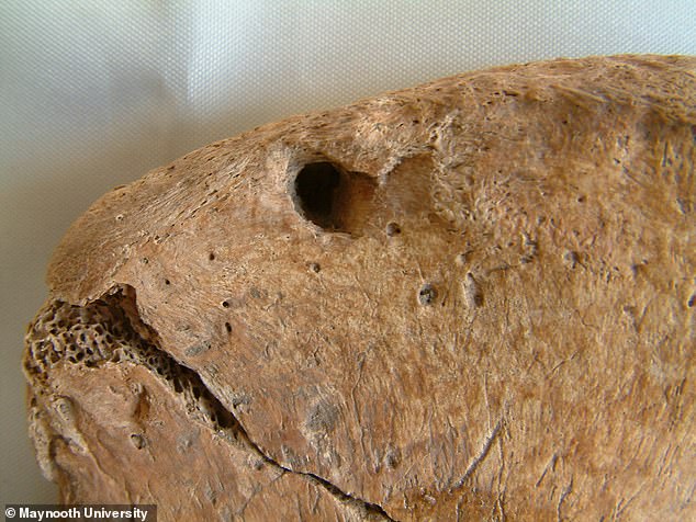 The fighter in question was a male, aged between 26 and 35, with a strong build and several healed injuries. The most notable observation was what appeared to be a bite wound found on his hip bone