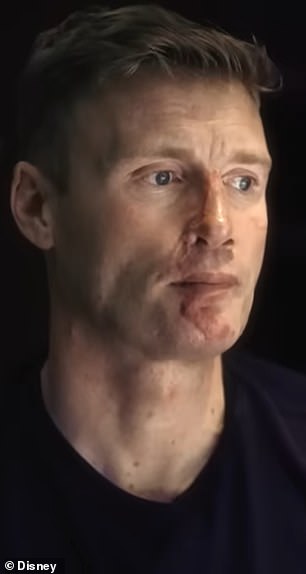 Flintoff had both hard and soft tissue damage
