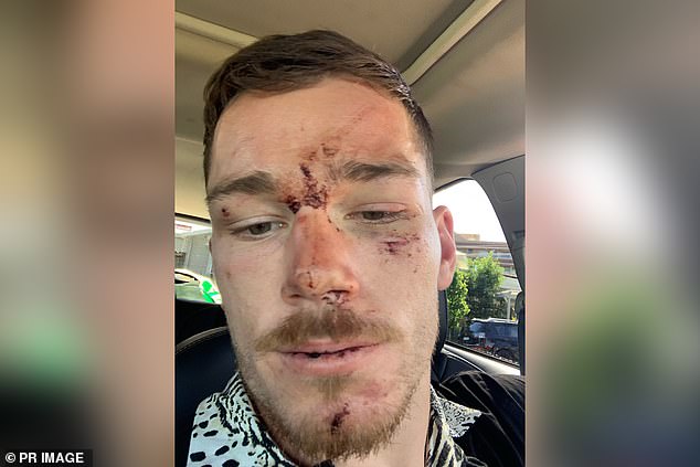 The Canberra Raiders star showed off the injuries he sustained following the alleged assault