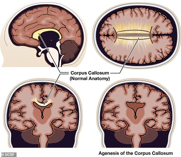 People with ACC lack part or all of the corpus collosum ¿ a bundle of more than 200 million nerve fibers that connects the left brain hemisphere to the right hemisphere.