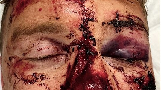 Gruesome footage of the extent of Andrew Flintoff's extensive injuries after his Top Gear crash have been revealed in his new Disney+ documentary