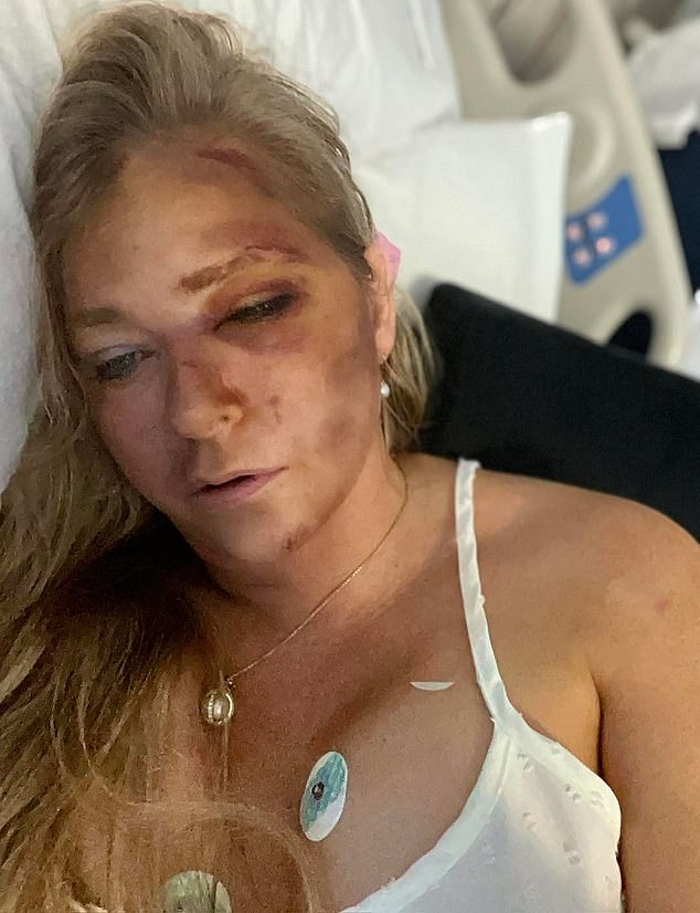 Virginia Giuffre sparked a social media firestorm in March when she shared a photo of her 'battered and bruised', claiming that she was dying after being hit by a school bus (pictured)