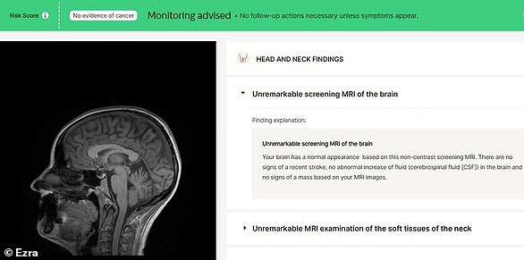 My brain scan results showed there was 'no evidence of cancer' and no follow-up actions were necessary