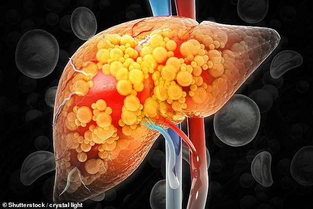NAFLD often develops silently, causing inflammation and eventially permanent scarring of the liver (stock image)