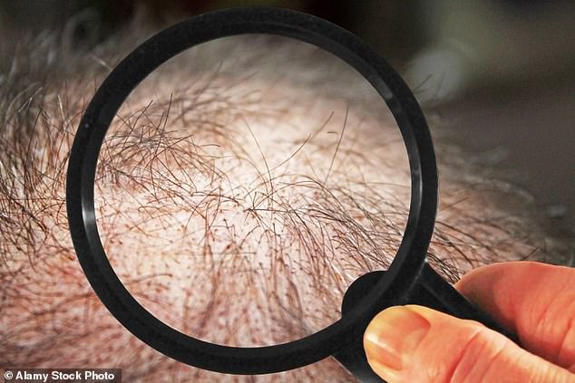 In the UK alone, it's estimated that over 15.4 million people suffer with hair loss. There are several treatment options available already - ranging from wigs to topical treatments. However, many of these are costly, and few are 100 per cent effective