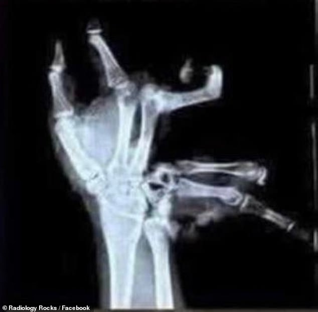 While the majority of firework-related accident involve severe burns, X-rays posted online revealed how many people have hand their bones horribly mangled in the explosions