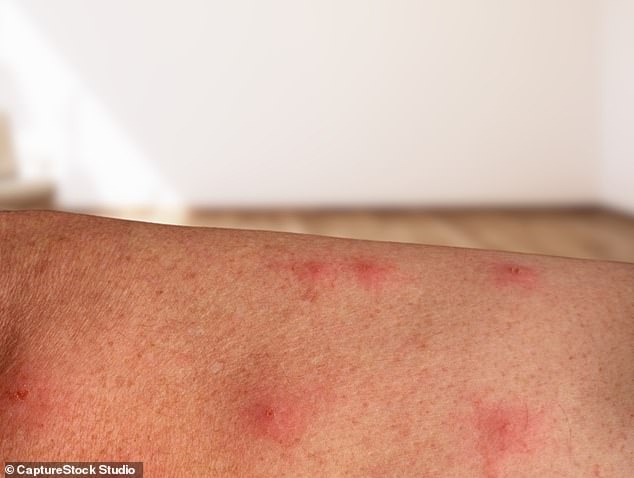 Monkey pox, a rare viral infection, causes causes spots, bumps or blisters on the skin. Monkey pox can be passed on from person to person by clothing, bedding or towels