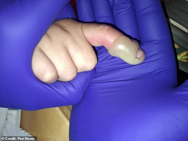 A blister appeared on his finger, and that night 'it seemed to blow up', quadrupling in size as it filled with pus
