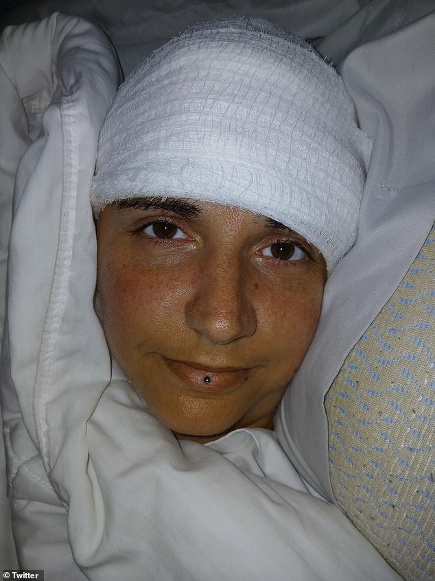 Surgeons drilled a hole into Crews' skull, placing the N1 implant on her motor cortex