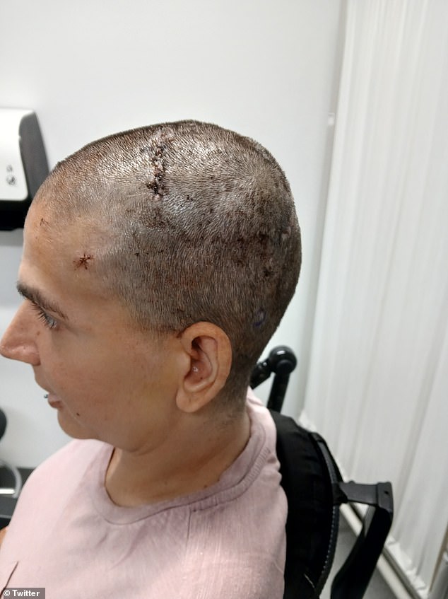 The implant on Crews' brain detects electrical impulses and sends those signals via Bluetooth to a specialized Neuralink program on a computer