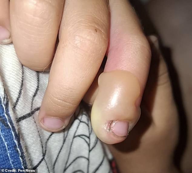 A toddler was left with second-degree burns and an agonising blister 'the size of a plum' after a brush with 'Britain's most dangerous plant'