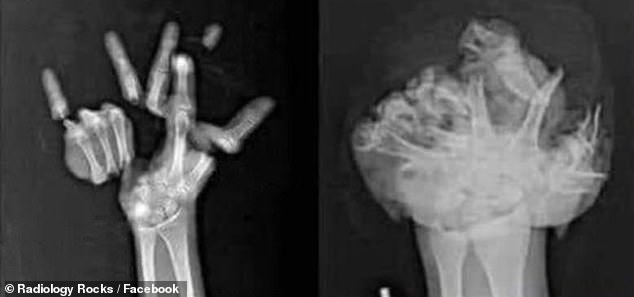A collection of X-rays warning about the dangers of Fourth of July fireworks was posted by Radiology Rocks on Facebook. In one instance, a fireworks accident victim appears to have lost all 5 of their fingers and most of their hand in the blast (right)