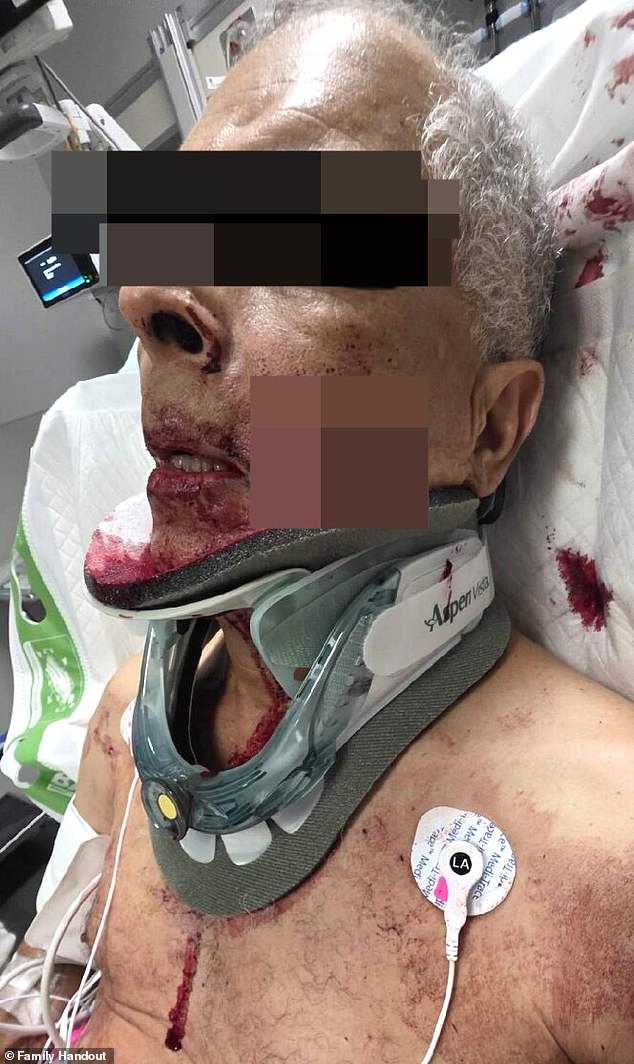The trucker was cut during an altercation with ex-NFl star Mark Sanchez in Indianapolis early Saturday morning, suffering a laceration that went through his cheek and hit his tongue