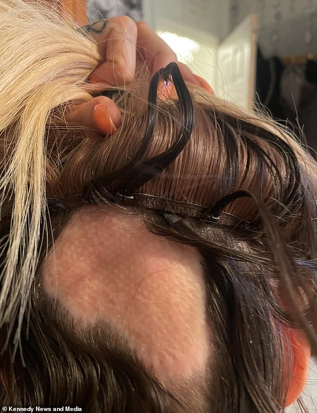 Others have told how doctors have warned them the hair will never grow back as there are no follicles in the skin