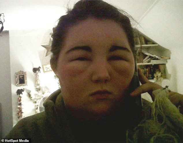 Robyn Cherry from Cheltenham, Gloucestershire, was left unable to see and her face doubled in size after dying her hair brown back in 2010 - despite undergoing a patch test