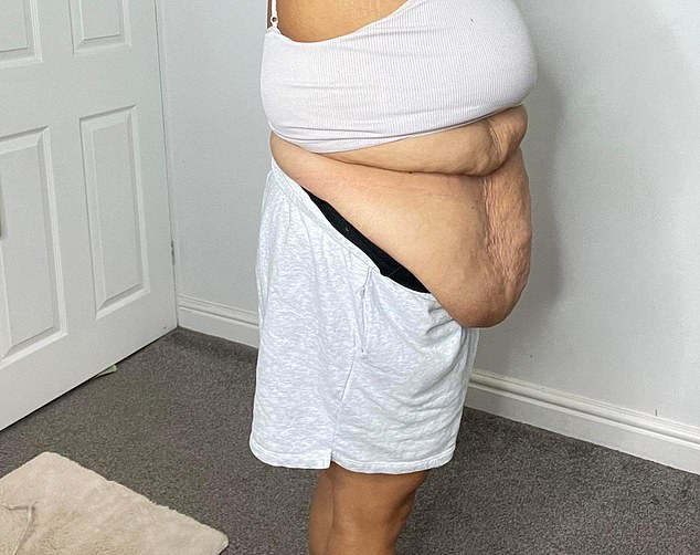 Genna underwent a gastric sleeve operation, in which around 85 per cent of the stomach is removed, but it left her with 2st of excess skin