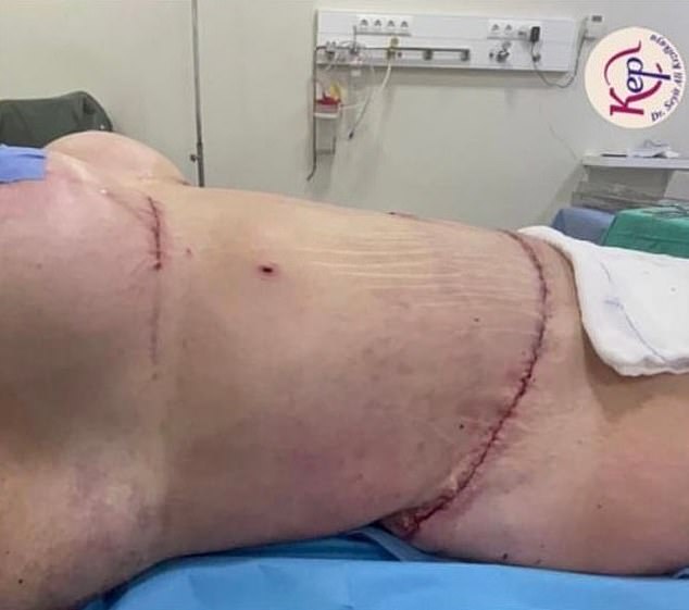 In September 2022 Genna underwent a lower tummy tuck, arm lift and back and front liposuction to remove the excess skin