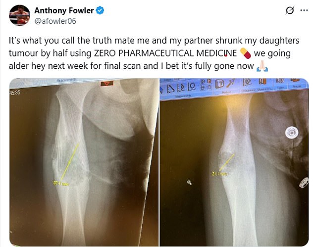 Fowler claimed that a combination of CBD, his wife¿s organic cooking, ¿bone broth¿ and turmeric ¿ rather than chemotherapy ¿ had reduced the size of his daughter¿s tumour