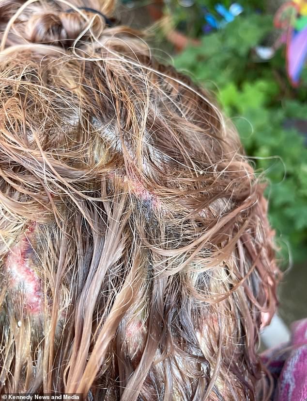 Photos posted online show how some have been forced to have half of their heads shaved or even undergo skin grafts to replace dead skin on the back of their heads