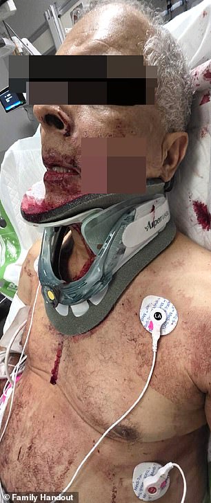 The trucker was cut during an altercation with ex-NFl star Mark Sanchez in Indianapolis early Saturday morning, suffering a laceration that went through his cheek and hit his tongue