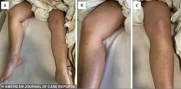 On the third day of her hospitalization, photographs documented significant and unusual swelling in both of the patient's legs. A shows the swelling in both legs. B is a close-up view of the right thigh and leg. C is a close-up view of the left thigh and leg