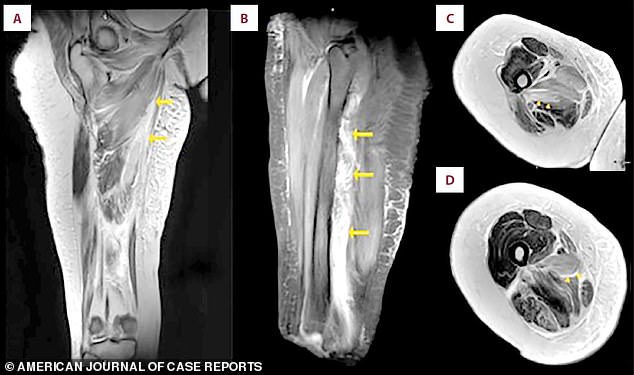 An MRI scan of the patient's right thigh revealed widespread muscle swelling. The images, marked with arrows, pinpointed this fluid buildup in the inner thigh muscles (the adductor group) and, in a different view, showed similar swelling affecting the muscles at the back of the thigh