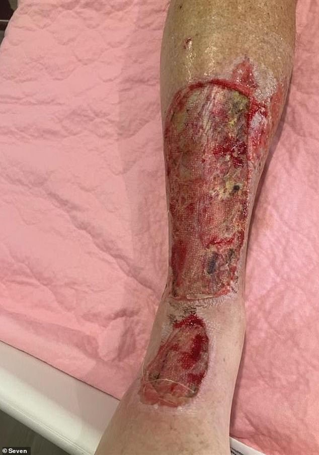 Doctors at The Avenue Hospital in Melbourne have told Findlay that he may need to spend the next month in hospital to undergo multiple skin grafts on his injuries (pictured)