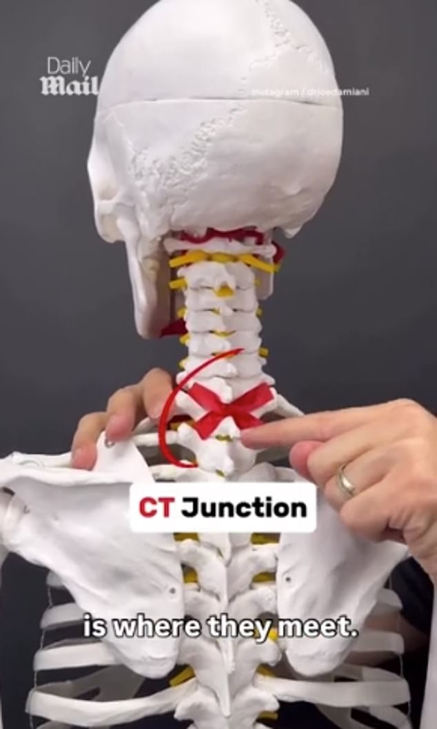 Dr Joe Damiani, a head and neck specialist, has said a 'neck hump' is likely to blame for the issue. A common term for the rounded hump at the base of the neck and upper back, it is located at the cervicothoracic (CT) junction