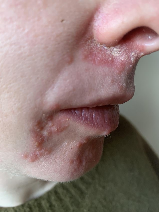 My skin two weeks on from when the condition started... I'd seen no progress