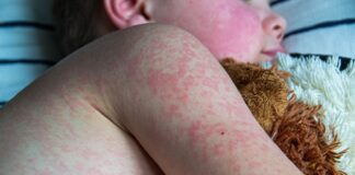 UK loses measles elimination status, warns WHO | UK News