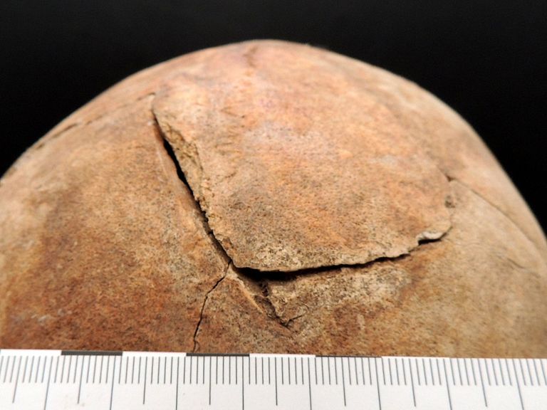 The deadly head wound that killed the Racesa 'vampire'. Pic: Natasa Sarkic