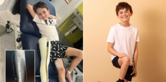Northamptonshire schoolboy Alfie Phillips, 9, has legs made longer in groundbreaking new surgery