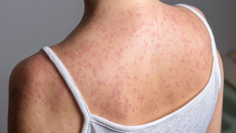 Measles causes cold-like symptoms, a rash and spots in the mouth. Pic: iStock
