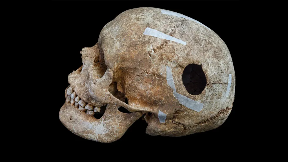 The skull of an abnormally tall man with a 3cm hole in his head