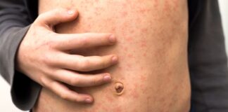 ‘Fast-spreading’ measles outbreak in north London leaves over 60 children infected | UK News