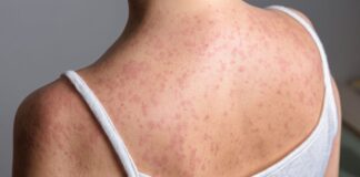 Measles cases continue to rise in England – and this is where outbreak could spread next | UK News