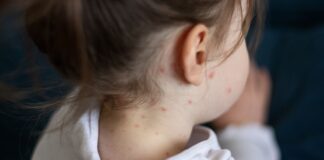 What are the symptoms of measles – and what should you do if you think your child is infected? | UK News